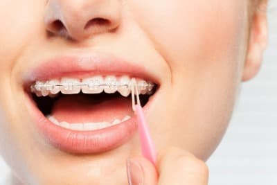 Why rubber band on braces?